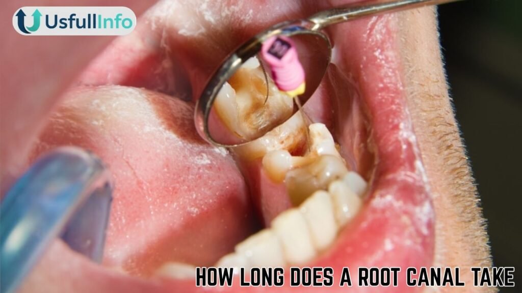 How Long Does a Root Canal Take